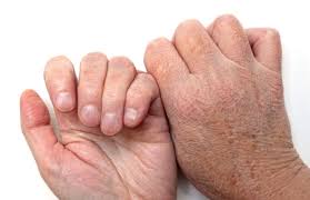 اصلی‌ترین عامل خشکی پوست دست و پا