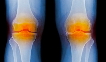 پیشگیری از آرتروز با یک هیدروژل تزریقی جدید