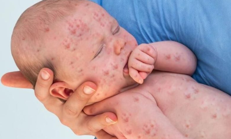 هشدار وزارت بهداشت درباره شیوع بیماری سرخک هر چه سریعتر کودکان را ایمن کنید
